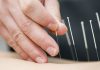 dry needling