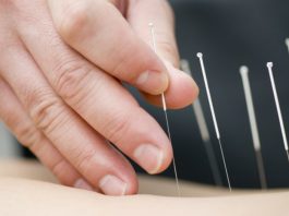 dry needling