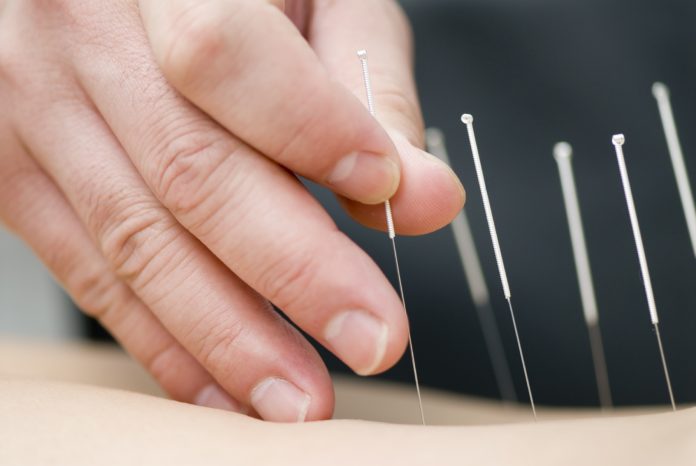 dry needling